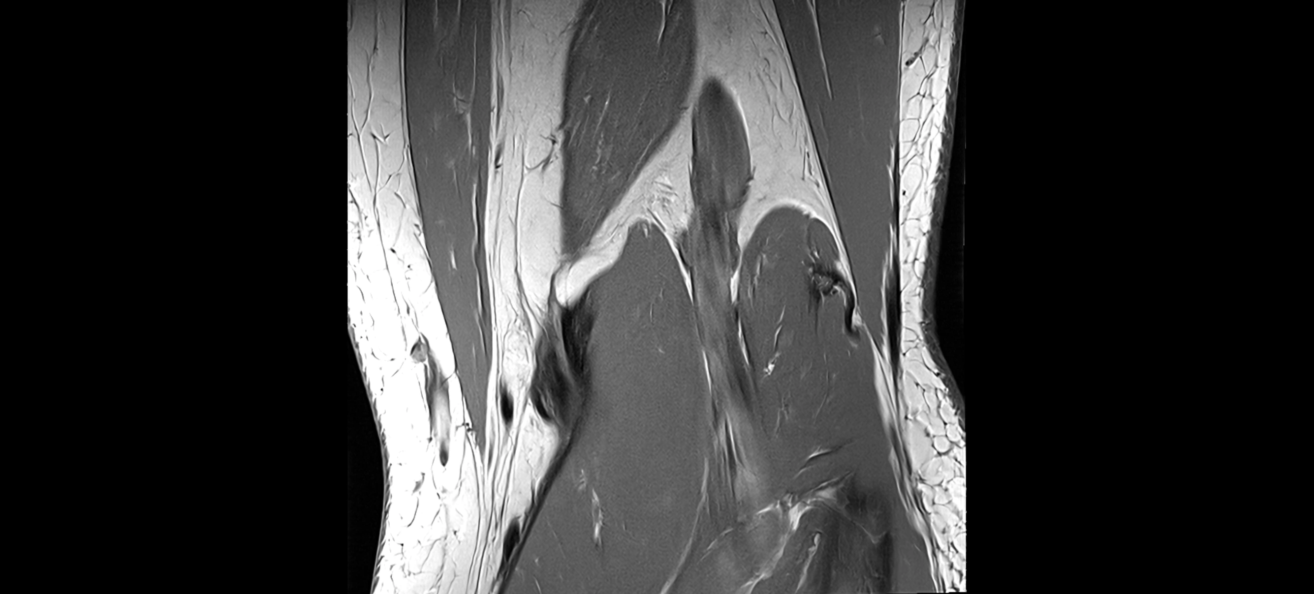 MRI coronal  ligaments cross sectional anatomy 3T  radiology  image-img-04001-00032.webp